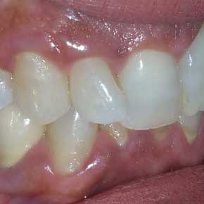 ציפוי שיניים