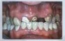 השתלת שיניים - איבוד עצם