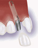 השתלת שיניים - שחזור של שן חסרה בודדת