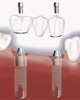 השתלת שיניים - שחזור מספר שיניים חסרות