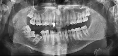 צילום שיניים דיגיטלי