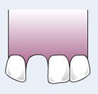 השתלת שיניים - השלבים