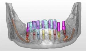  השתלת שיניים ללא ניתוח - השתלת שיניים ממוחשבת