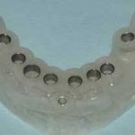 השתלת שיניים ללא ניתוח - השתלת שיניים ממוחשבת