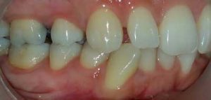 יישור שיניים עם קשתיות שקופות
