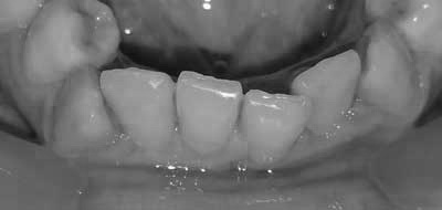 Ортодонтия невидимка прозрачными каппами