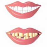 חבלה בשיניים קדמיות