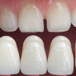 ציפוי חרסינה לשיניים