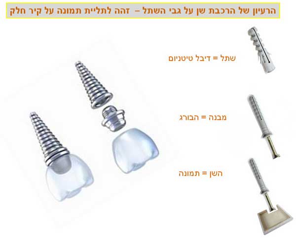 השתלות שיניים 