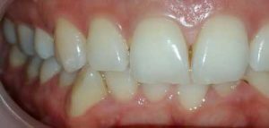 יישור שיניים בקשתיות שקופות בבאר שבע